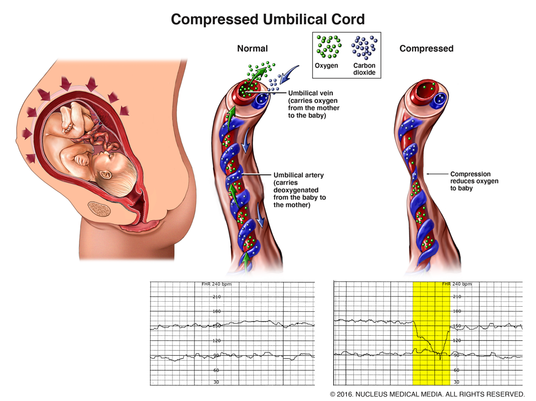 A compressed umbilical cord can limit the oxygen and nutrients delivered to the unborn child.
