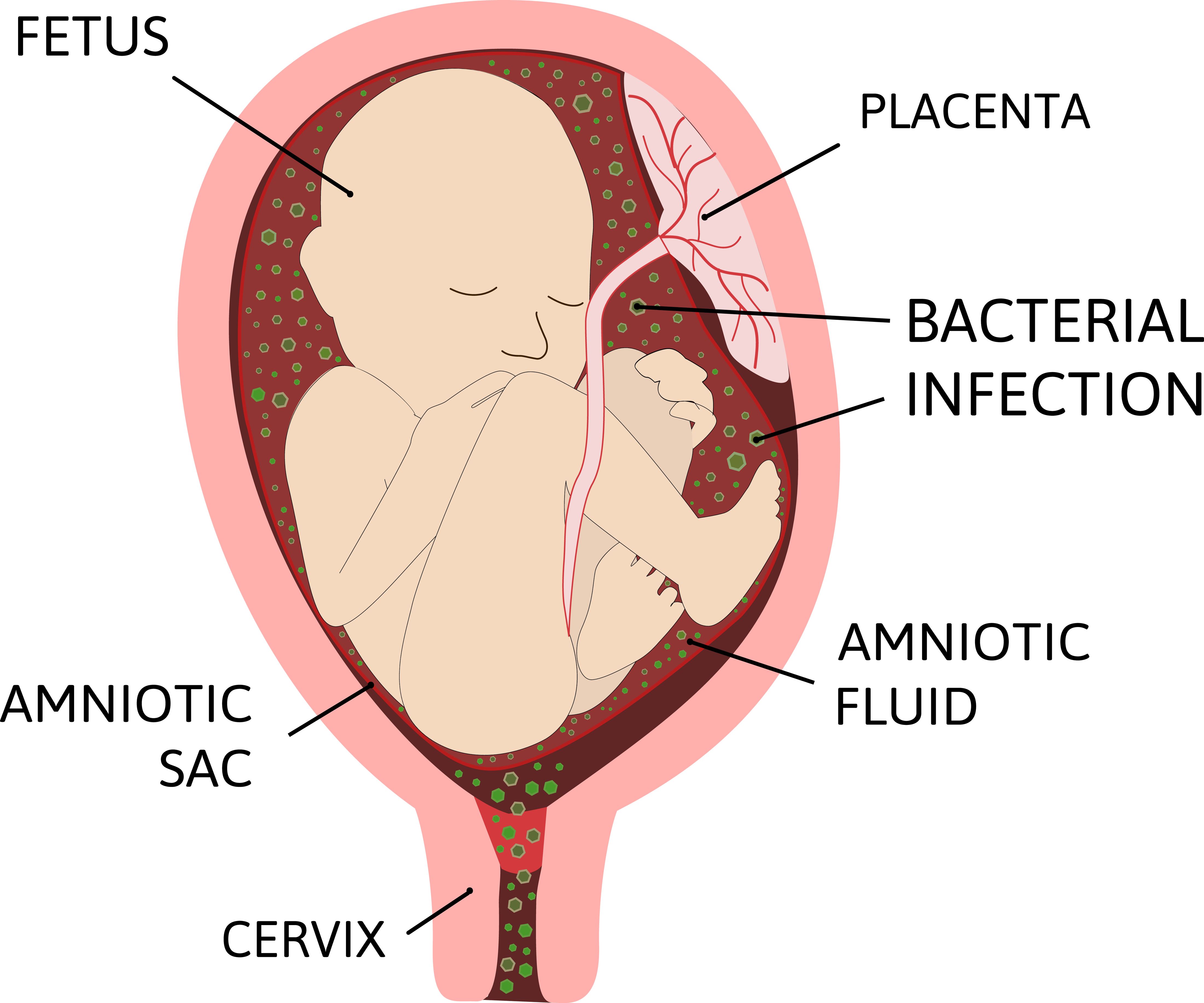 Chorioamnionitis is an inflammation of the fetal membranes (amnion and chorion) due to a bacterial infection.