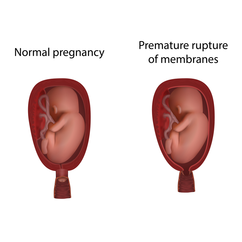 Normal and premature rupture of membranes. Preterm premature rupture of membranes occurs when your water breaks before 37 weeks gestation. 