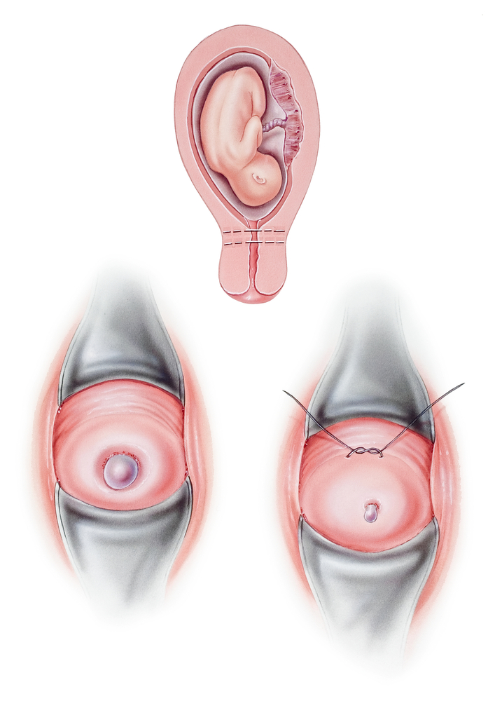 Cervical Cerclage, a surgery used to keep a cervix closed during pregnancy.
